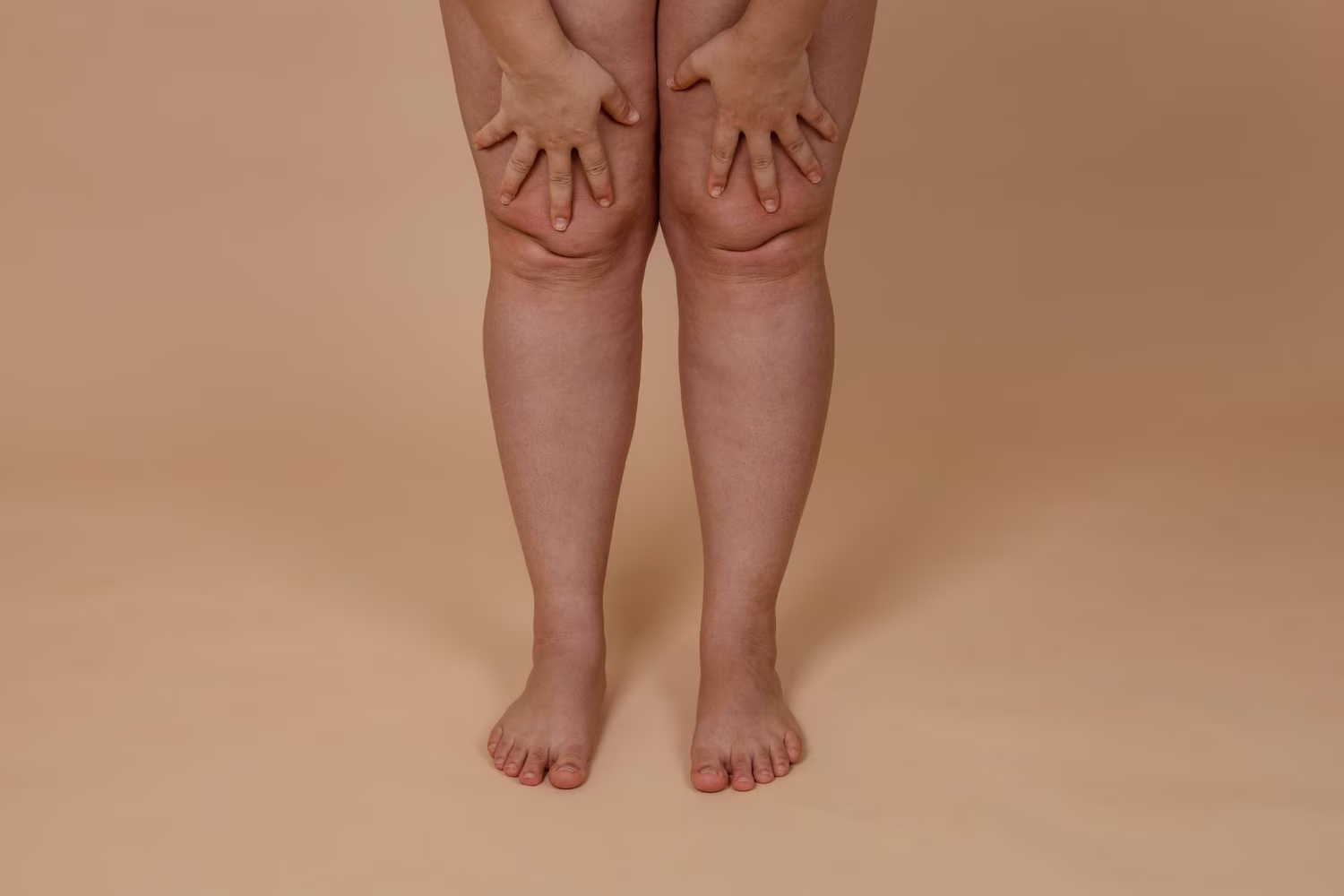 Traoitement lipœdème lymphœdème au Maroc